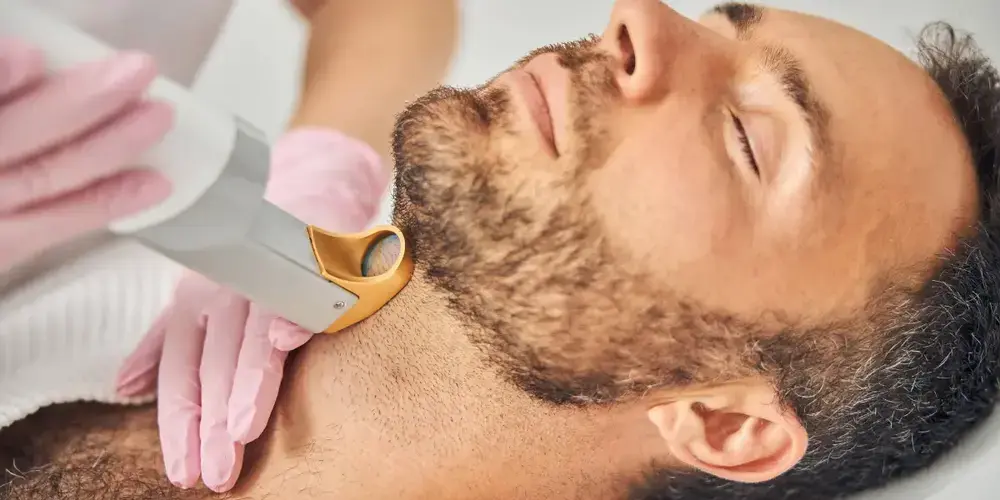 Depilação a Laser na Barba